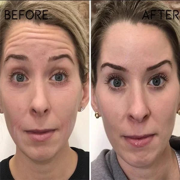 🌱Last Day Promotion 70% OFF🔥-Botox Facial Essence💖💖