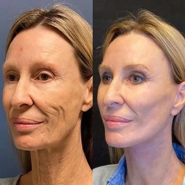 🌱Last Day Promotion 70% OFF🔥-Botox Facial Essence💖💖