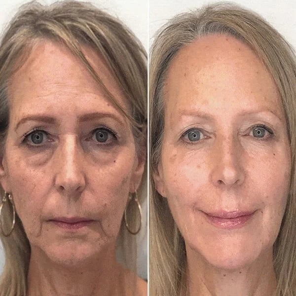 🌱Last Day Promotion 70% OFF🔥-Botox Facial Essence💖💖