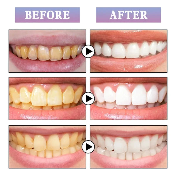 🔥Last Day 80% OFF🔥Glostik Tooth Gloss🔥BUY 2 GET 1 FREE
